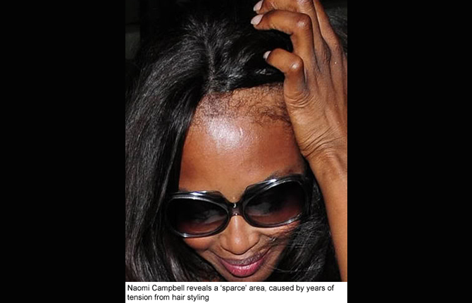 Perte des cheveux chez la femme: les meilleurs remèdes et traitements